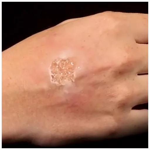 Grimas Blister Gel smink, hólyagok szimulálására